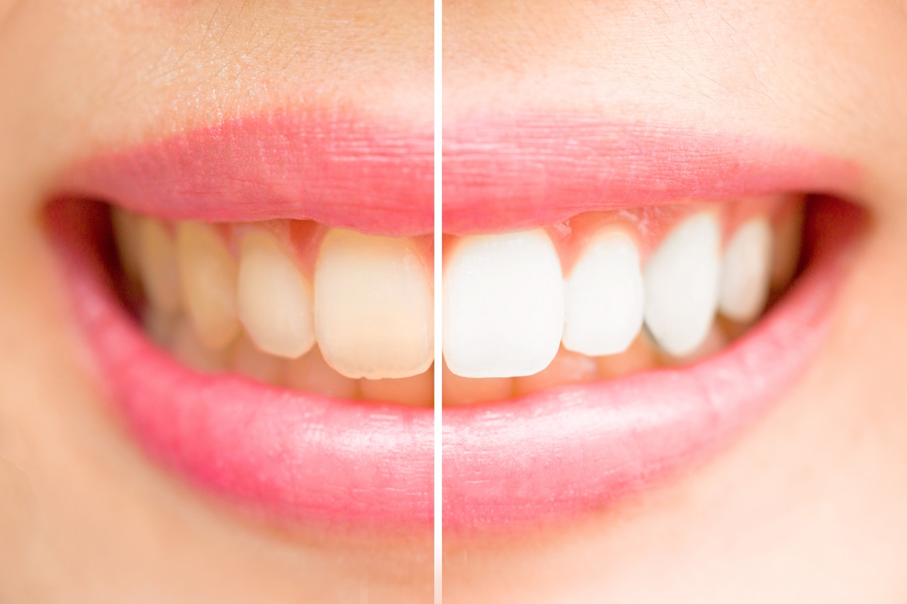 Wybielanie zębów – jakie są sposoby?